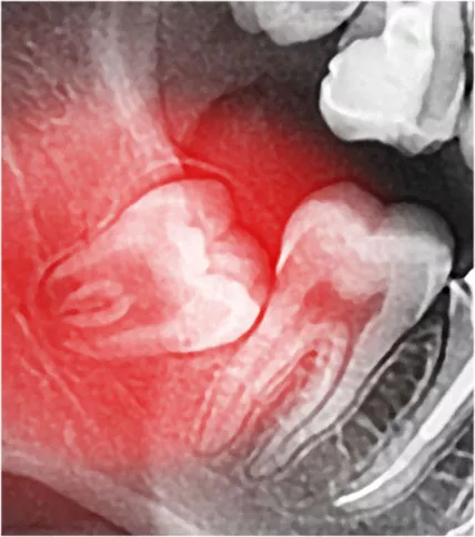 X-Ray of wisdom teeth.