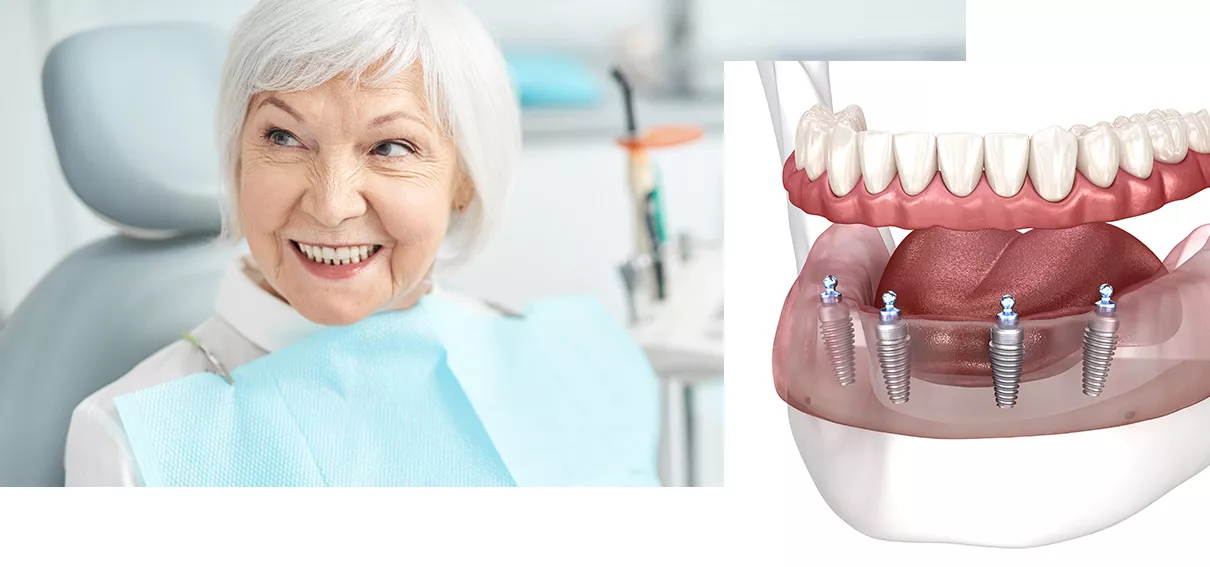 dental-implants