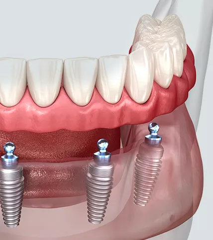 Model of implant supported denture